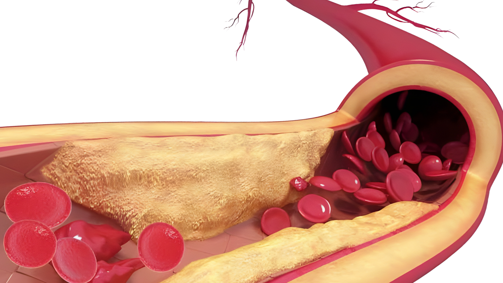 Advances in coronary imaging of atherosclerotic plaques