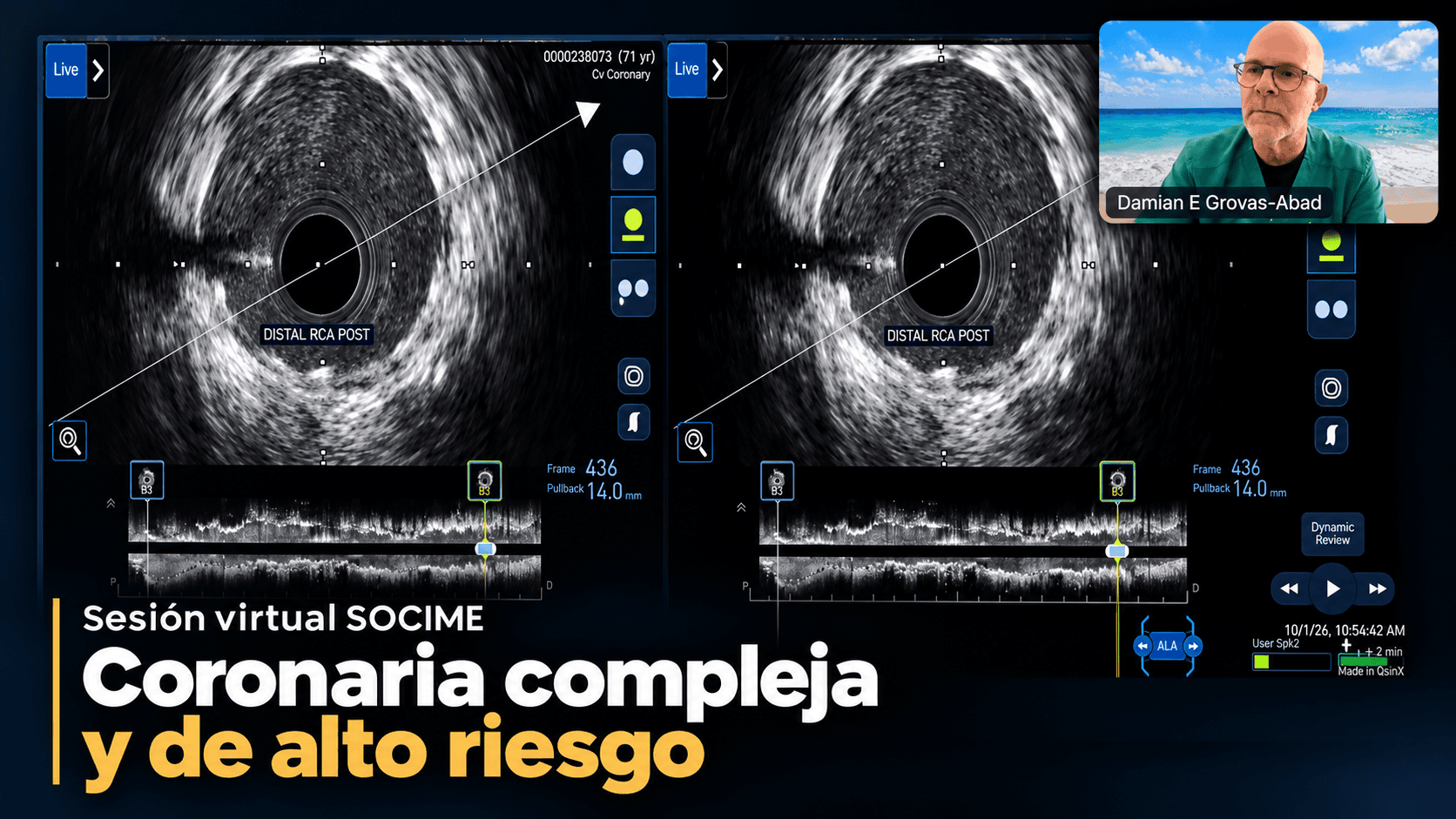 SOCIME realiza sesión virtual sobre enfermedad coronaria compleja y de alto riesgo